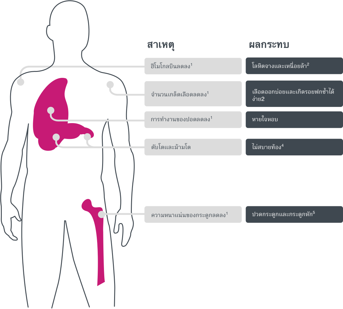 แผนภาพประกอบเกี่ยวกับอาการของโรคโกเช่ร์ (Gaucher) 